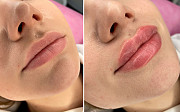Високоякісна контурна пластика губ - омолодження і збільшення губ Київ